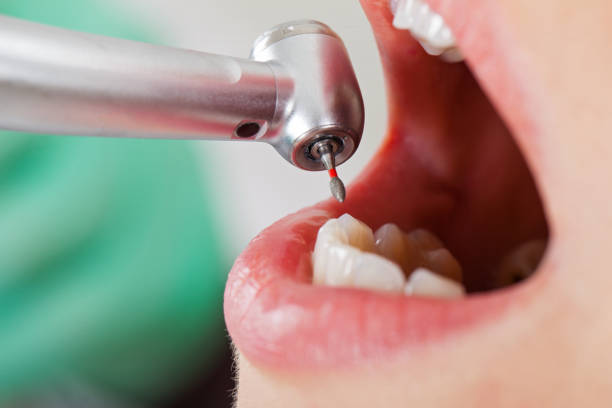 Best Knocked-Out Tooth (Avulsed Tooth) Treatment in Vernon, TX